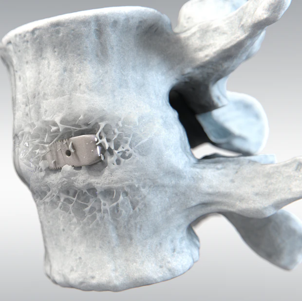 Medical Spine HA