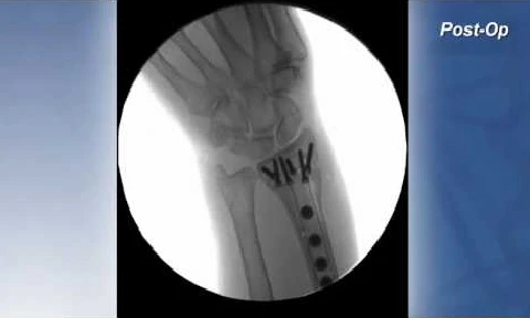 CASE STUDY Distal Radius Fracture