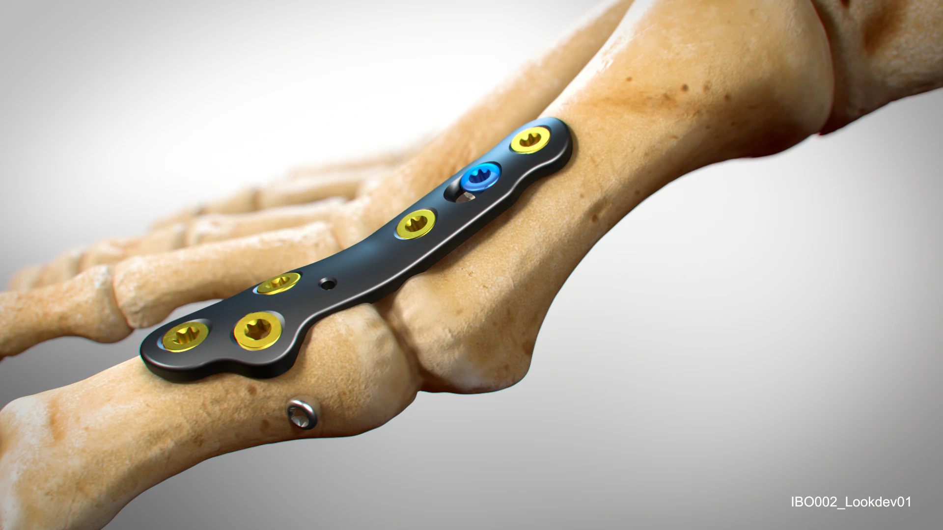 In2Bines CoLink plate on bone