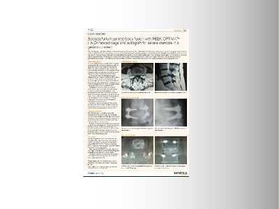 Timothy Bassett Spinal News