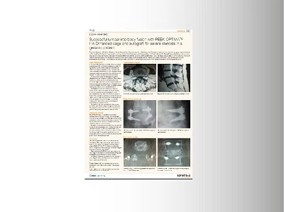 Timothy Bassett Spinal News