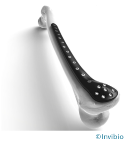 Trauma fixation plate made with Invibio PEEK-OPTIMA™ (CFR-PEEK).