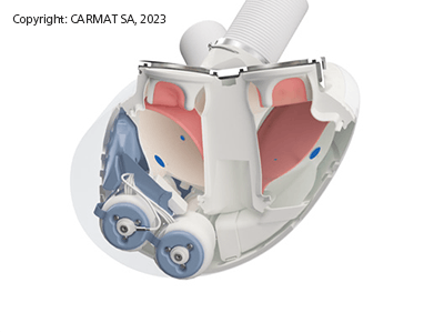 Carmat Total Artificial Heart