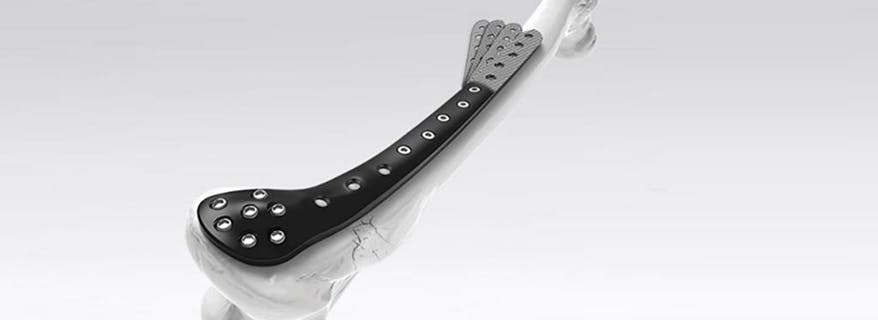 PEEK-OPTIMA Ultra-Reinforced trauma plates on arm model 