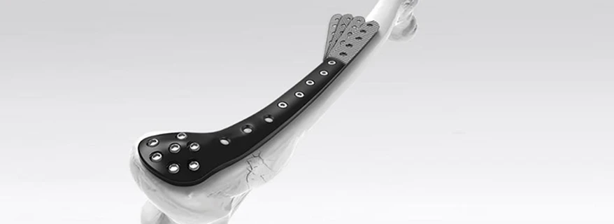 PEEK-OPTIMA Ultra-Reinforced trauma plates on arm model