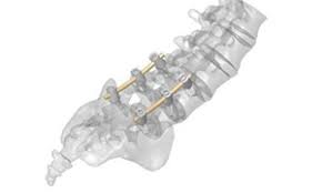 Medical PEEK OPTIMA spinal rods