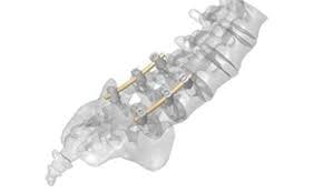 Medical PEEK OPTIMA spinal rods