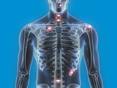 Skeleton highlighting implantable PEEK solutions