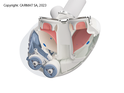 Victrex-ChangeMakers-CARMAT-Artificital Heart