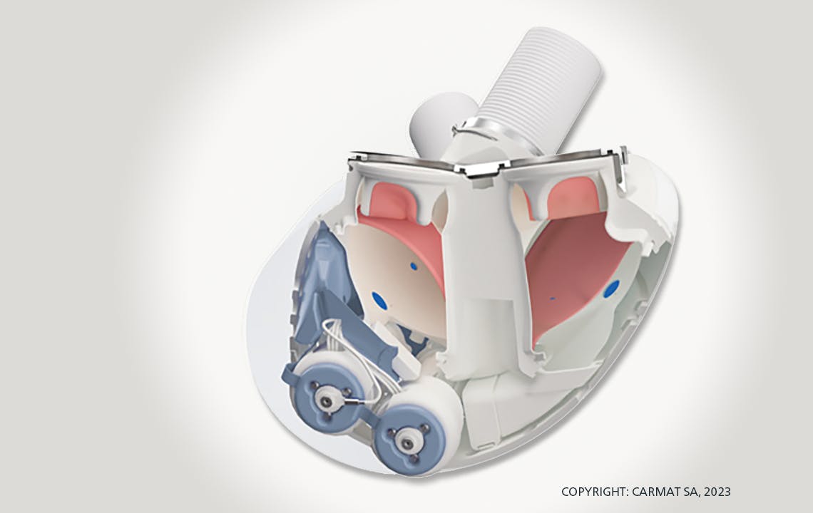 CARMAT Artificial Heart