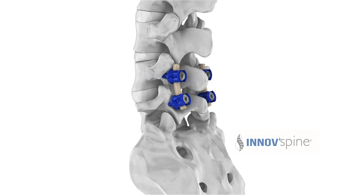 Vector Rods Spine Semi-rigid spinal rods now available to bridge treatment gap - Victrex