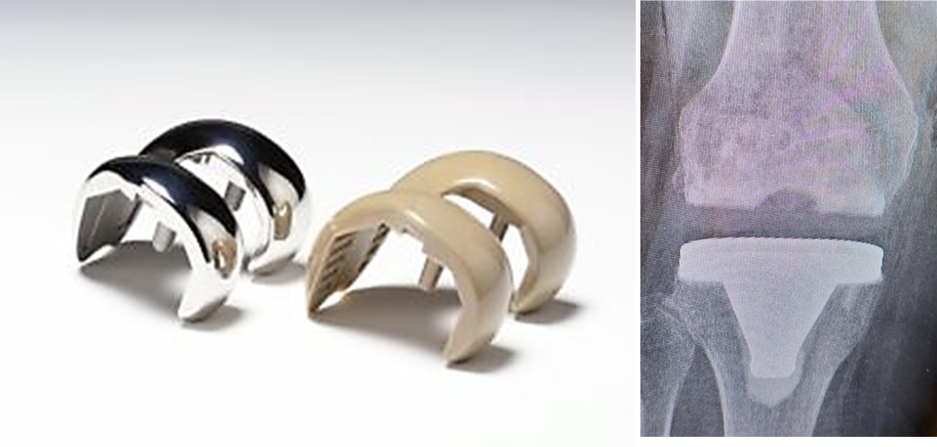 Freedom(r) Total Knee System with Invibio PEEK-OPTIMA Polymer compared with metal. X-ray illustrates radiolucent PEEK properties