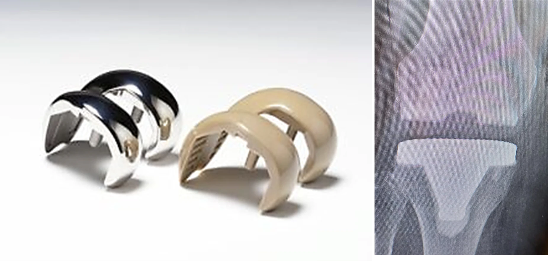 Freedom(r) Total Knee System with Invibio PEEK-OPTIMA Polymer compared with metal. X-ray illustrates radiolucent PEEK properties