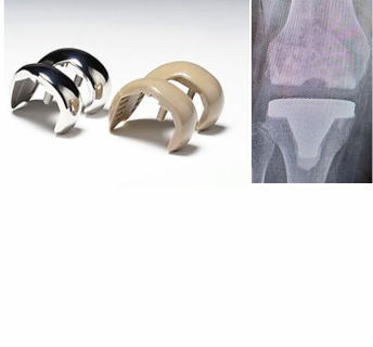 First PEEK-OPTIMA™ Cases Performed in US IDE Study with Maxx Orthopedics’ Freedom® Total Knee System