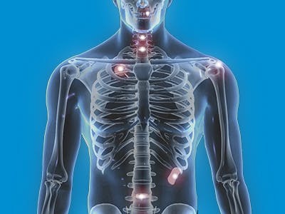 Skeleton highlighting implantable PEEK solutions