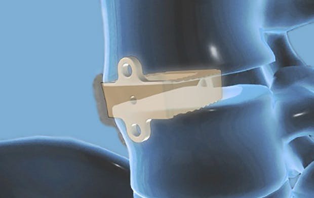 Spine fusion device 