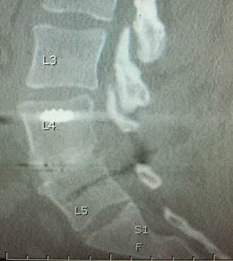 Solid Lumbar fusion at 6 months on CT scan with the EVOS-HA Lumbar Interbody System from Cutting Edge Spine.  Image courtesy of Timothy Bassett, MD.