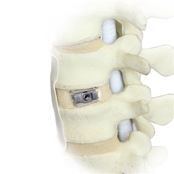 Uplifter™ Expandable Anterior Lumbar Interbody Fusion Device was demonstrated in a hands-on live  workshop in Shanghai. © Fule
